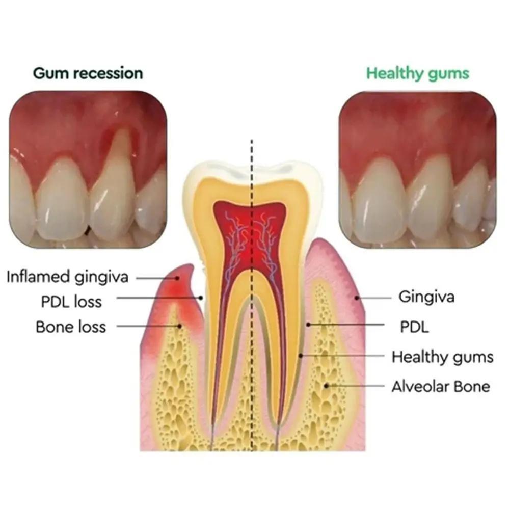 Gum Repair Drops Relieve Receding Gingival Swelling Gum Cleaning Care Oral Periodontal Hygiene Remove Yellow Remove Stain