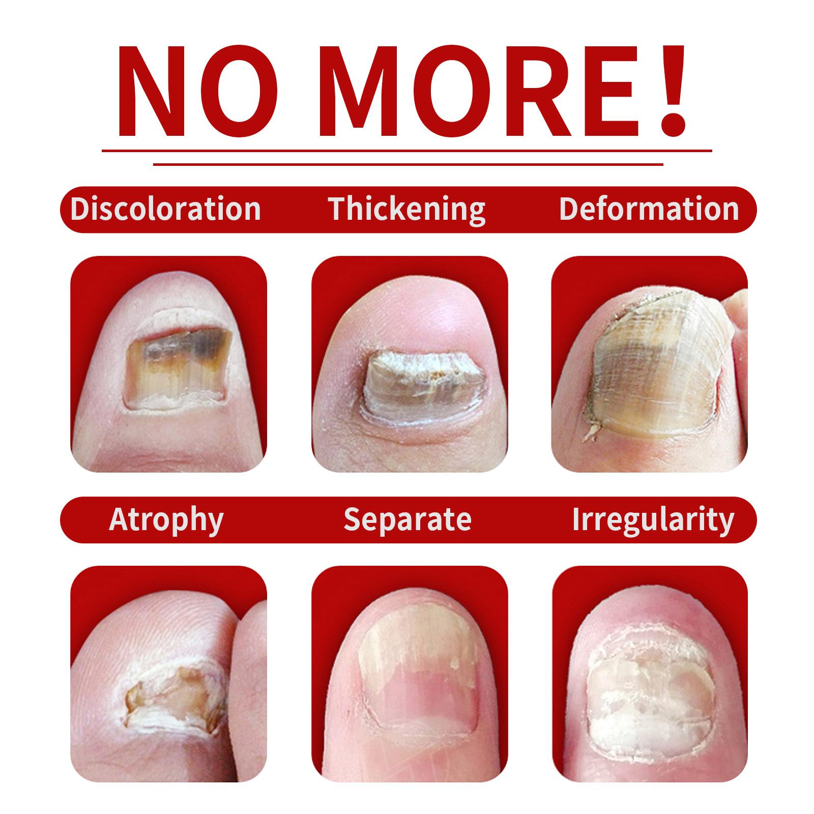 JAYSUING Ginger Nail Treatment | Vitamin E & Plant Essential Oils for Nail Care | Supports Recovery from Onychomycosis, Paronychia, & Nail Deformation | Nail Nutrient Strengthener Oil - Ginger Cuticle Care Oil for Nails