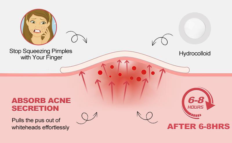 Pimple Patches for Face, Hydrocolloid acne Patches, 2 Size 180 Count Acne Patches, Spot Stickers with Salicylic Acid, Tea Tree Oil & Calendula Oil