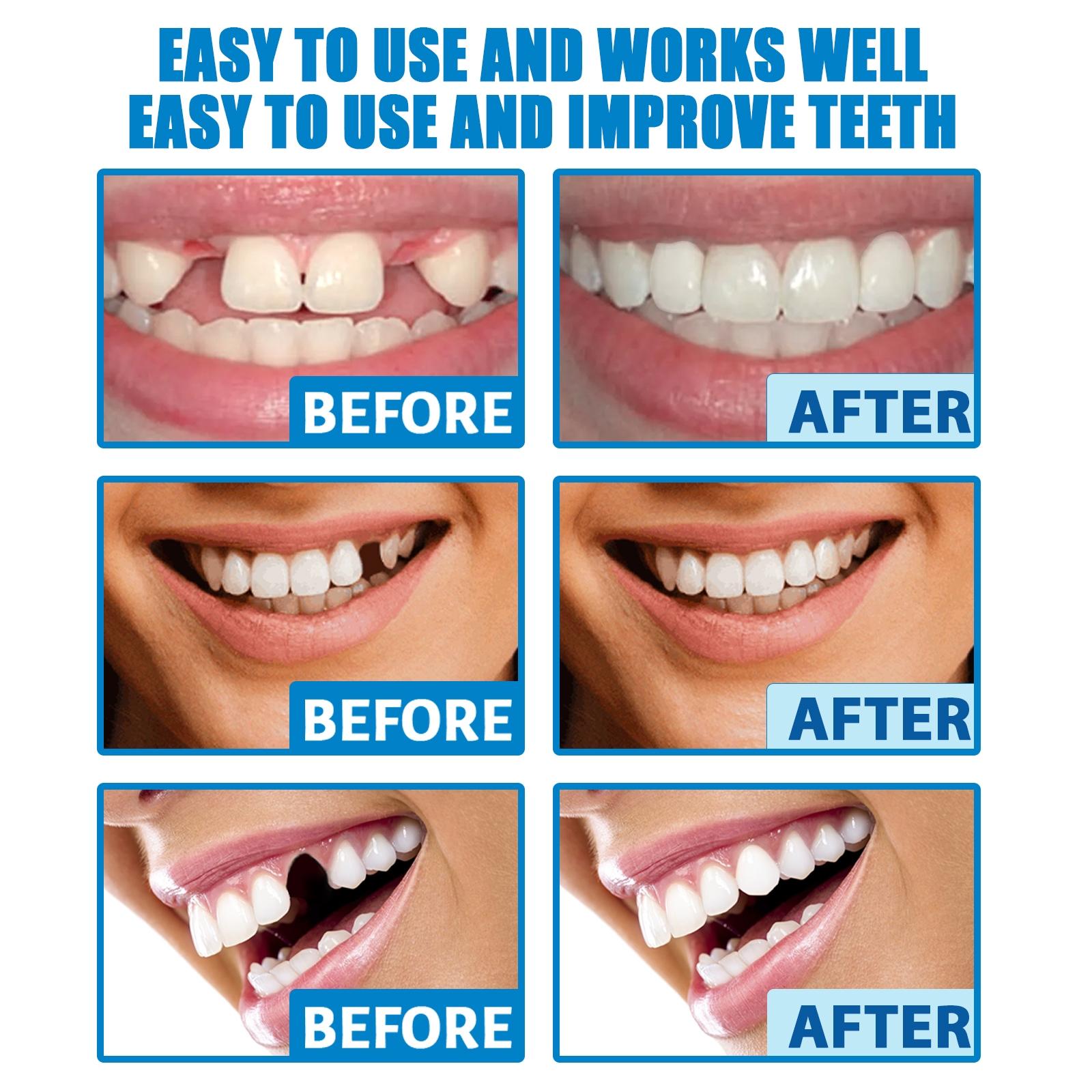 Moldable False Teeth, Dentures Teeth, Fake Teeth, Teeth Repair Kit, Comes with 4 repair tools, Veneer teet, Shapeable Denture RepairPellets for Broken Teeth & Missing Teeth-Oral Care Product, Ideal for Films, TV Programs, Halloween, Cosplay