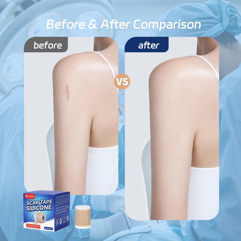 Medical Silicone Scar Patch 4cmx150cm, Professional Scar Repair Patch, Cesarean Section Scar Fade Patch, Adjustable Reusable