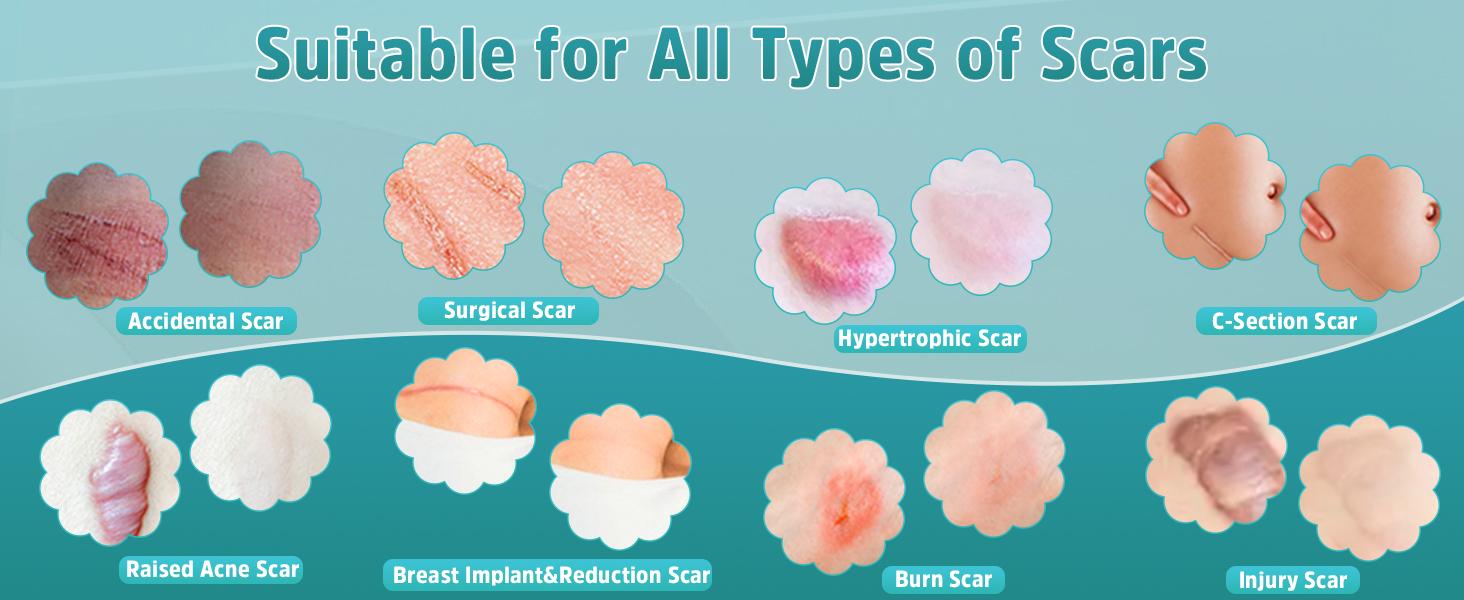 Scar Removal Gel Advanced Silicone Cream for Old New Scars Surgery Stretch Marks 1.7oz Scar Removal Gel Advanced Silicone Cream for Old New Scars Surgery Stretch Marks 1.7oz