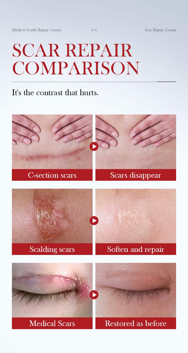 Scar Repair Gel - A lightweight formula for face and body that effectively fades acne scars and stretch marks