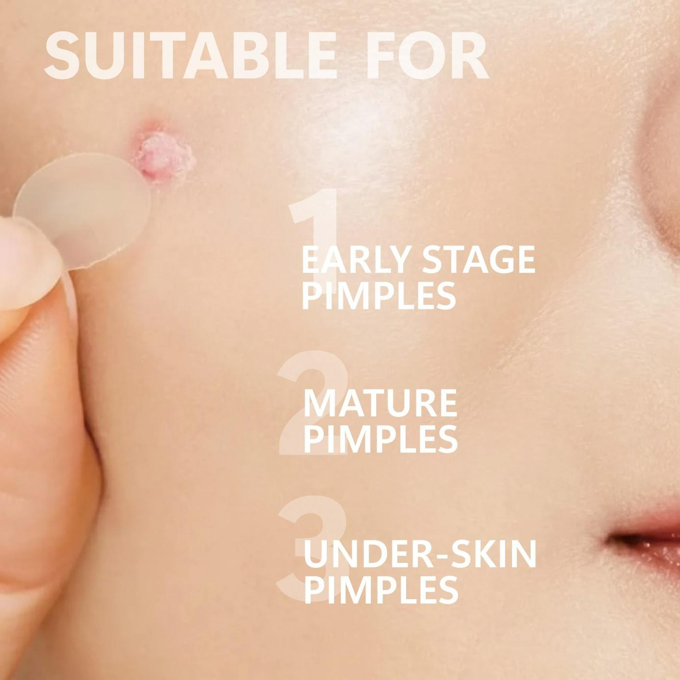 KHAZX 12/24pcs Microneedle Gentle Care Patches, Acne Treatment Patches, Single Item, Non-Flammable, Made in China