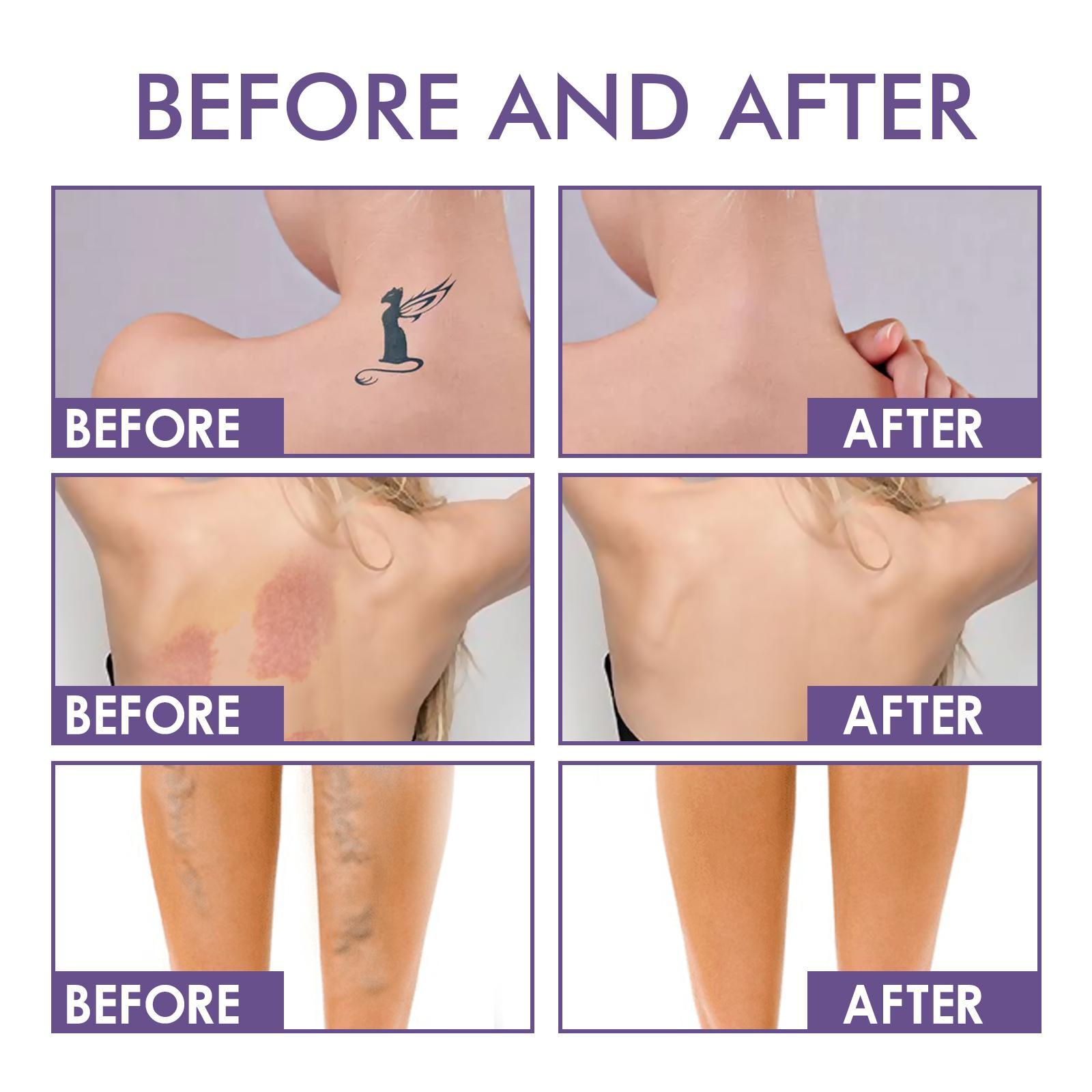 Body Concealer Makeup Waterproof No Transfer, Leg Vein Cover up Makeup for Varicose Veins Waterproof Black Skin, Leg and Body Scar Cover up Makeup for Tattoo Cover Up Oil Acne