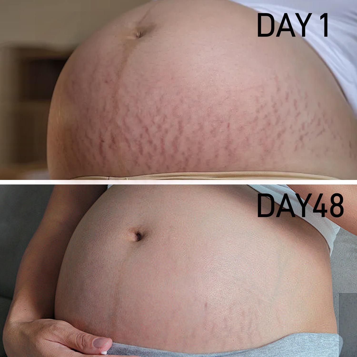 PEGO Stretch Mark Butter, Belly Moisturizer, Pregnant & Breastfeeding - Prevents & Heals Stretch Marks - Formula Enriched with Shea Butter & Vitamin E, 3.53 oz