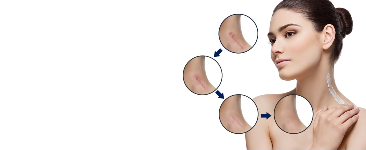 Scar Cream Gel, Advanced Silicone Scar Gel, Professional Scar Removal Cream for Surgical Scars, Stretch Mark, Keloid Bump, C-Section, Old and New Scars 1.7 oz(50g) Treatment Remedies Skin Tightening Oil Healthcare Therapeutic