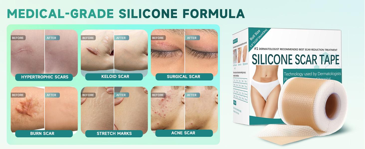 Scar Removal Silicone Tape 3M Roll (1.6 x 120) for Keloids, Surgical Scars C-Section & Burn Healing