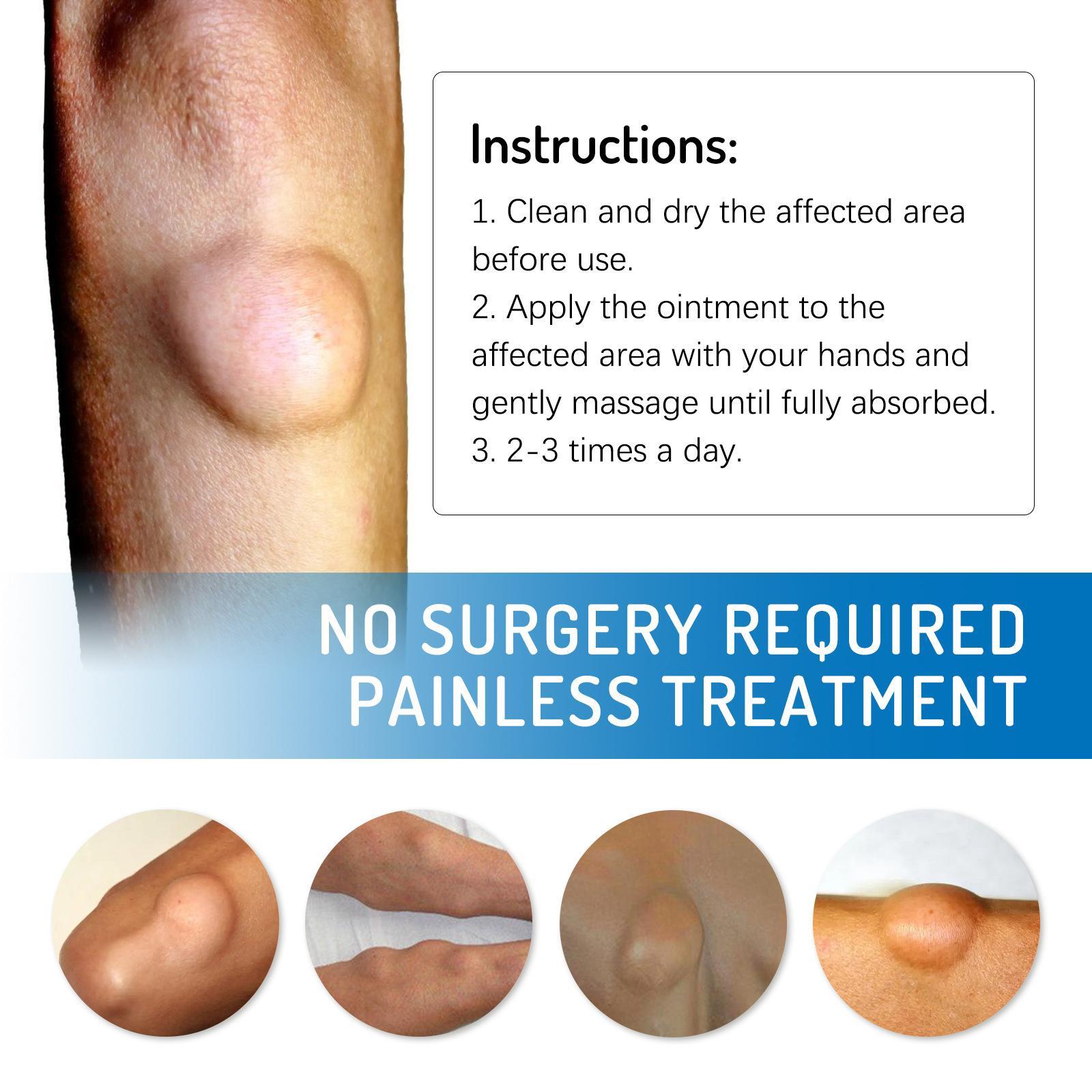 Relieve subcutaneous lumps caused by lipoma-fat cream