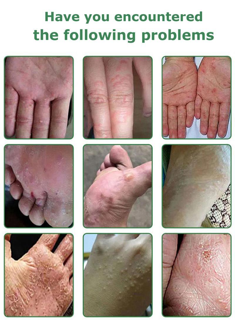 2026 All-Natural Soothing Cream for Eczema & Psoriasis – Herbal Relief for Dry, Itchy, Sensitive Skin , Anti-Bacterial Skin Defense (Hydrating, Safe for All Ages | 20g) Treatment