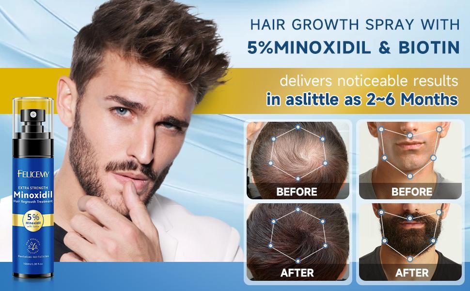 5% Extra Strength Minoxidil Spray for Hair & Beard Growth | Clinically Proven DHT Blocker Formula | Fast Results for Men & Women (3.4 fl.oz)