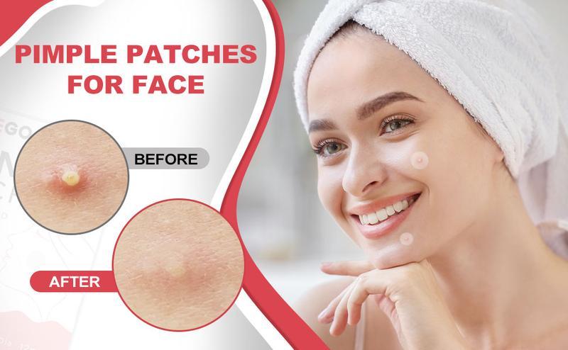 Pimple Patches for Face, Hydrocolloid acne Patches, 2 Size 180 Count Acne Patches, Spot Stickers with Salicylic Acid, Tea Tree Oil & Calendula Oil