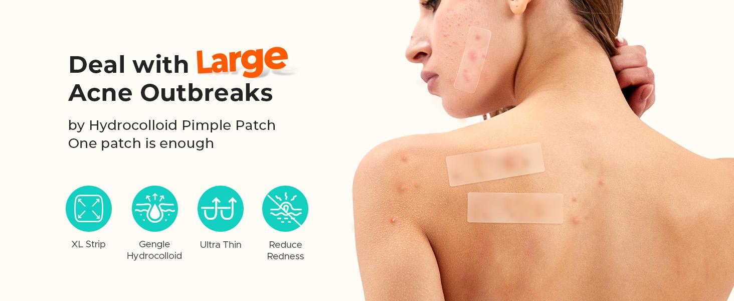 TKTK  Large Pimple Patches for Face(Strip, Contoured, Dot 5 Sizes 300 Count) , Acne Patches 60 x 20 mm, XL Hydrocolloid Bandages for Forehead,Chin,Full Face,Back,Neck and Body Skincare,acne clearing products,pimple patch #SpringStatements