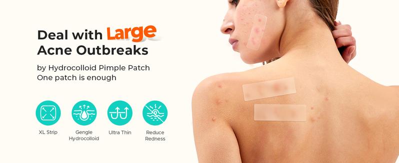 TKTK  Large Pimple Patches for Face(Strip, Contoured, Dot 5 Sizes 300 Count) , Acne Patches 60 x 20 mm, XL Hydrocolloid Bandages for Forehead,Chin,Full Face,Back,Neck and Body Skincare,acne clearing products,pimple patch,TikTokShopLaborDaySale