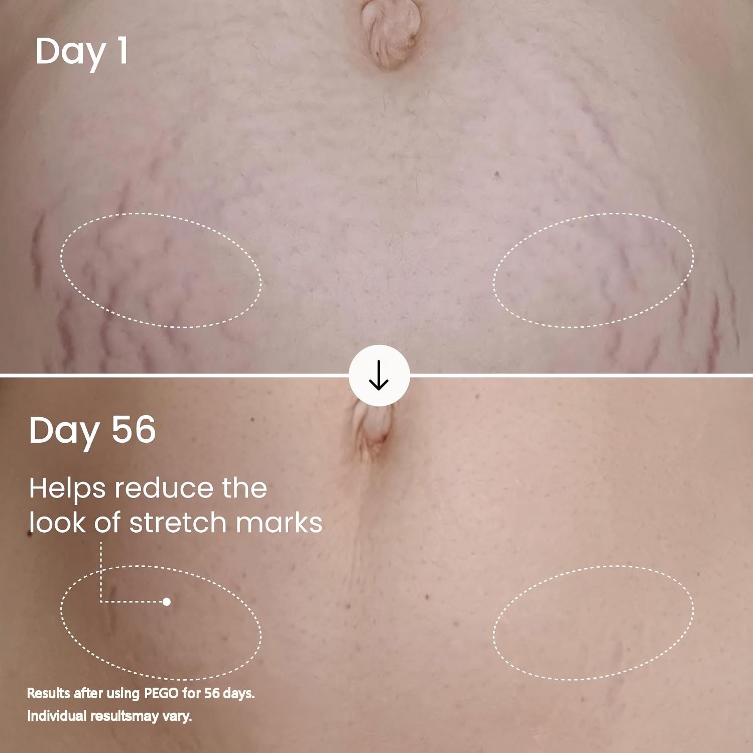 Gentle Repair Cream, Massage Balm, Firming Cream, Anti Stretch Marks, Reduces Stretch Marks, Prevents Pregnancy Belly Lines, Postpartum Recovery, Deep Moisturizing, Stretch Mark Cream For Pregnancy