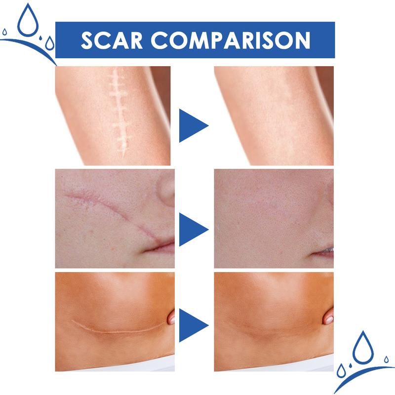 Professional Scar Removal Gels Advanced Silicone Scar Removal Cream for Burn Acne Old Scar Removal Cream for Face & Body Fades Dark Scars All Natural Ingredients Gentle Formula