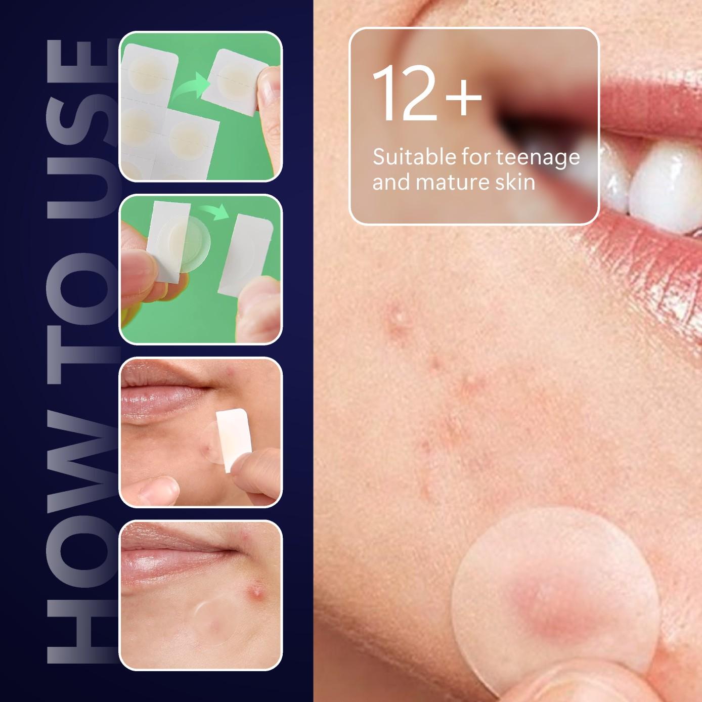 12/24 Pcs Micro Needle Acne Patch, Contains Salicylic Acid Hyaluronic Acid Tea Tree Oil, Single Pack Acne Care, Anti-Acne Treatment