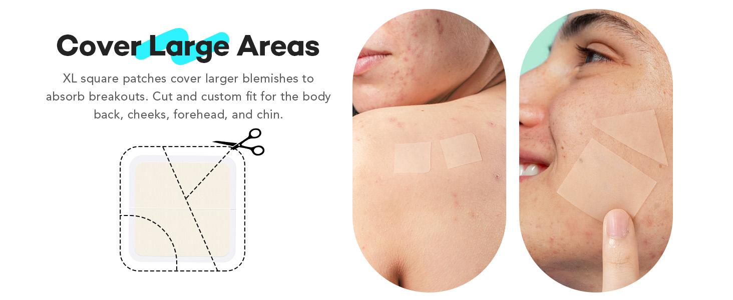 LitBear Large Pimple Patches for Face (6 Sizes 401 Patches), Big Hydrocolloid Acne Patches, XL Hydrocolloid Bandages for Body, Cheek, Forehead, Chin, Full Face, Back, Nose, Acne patch & Pimple patch LitBear Large Pimple Patches for Face (6 Sizes 401 Patches), Big Hydrocolloid Acne Patches, XL Hydrocolloid Bandages for Body, Cheek, Forehead, Chin, Full Face, Back, Nose, Acne patch & Pimple patch