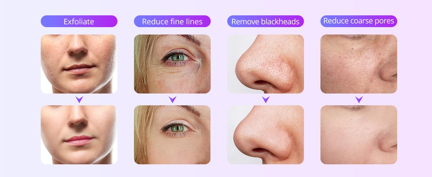 UNOISETION Diamond Microdermabrasion Machine Professional, 3 in 1 Demabrasion Facial Peeling Skin Care Device for Salon Personal Home Use, SR-NF105U