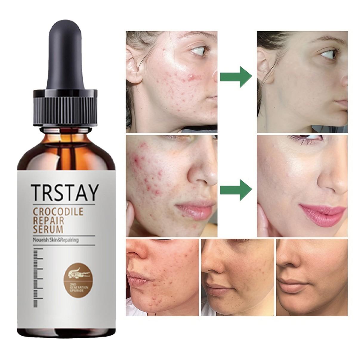 Trstay Facial Serum with Witch Hazel & Arbutin, Moisturizes, Soothes Irritated Skin, Minimizes Pores, Fades Pigmentation, Brightens Complexion