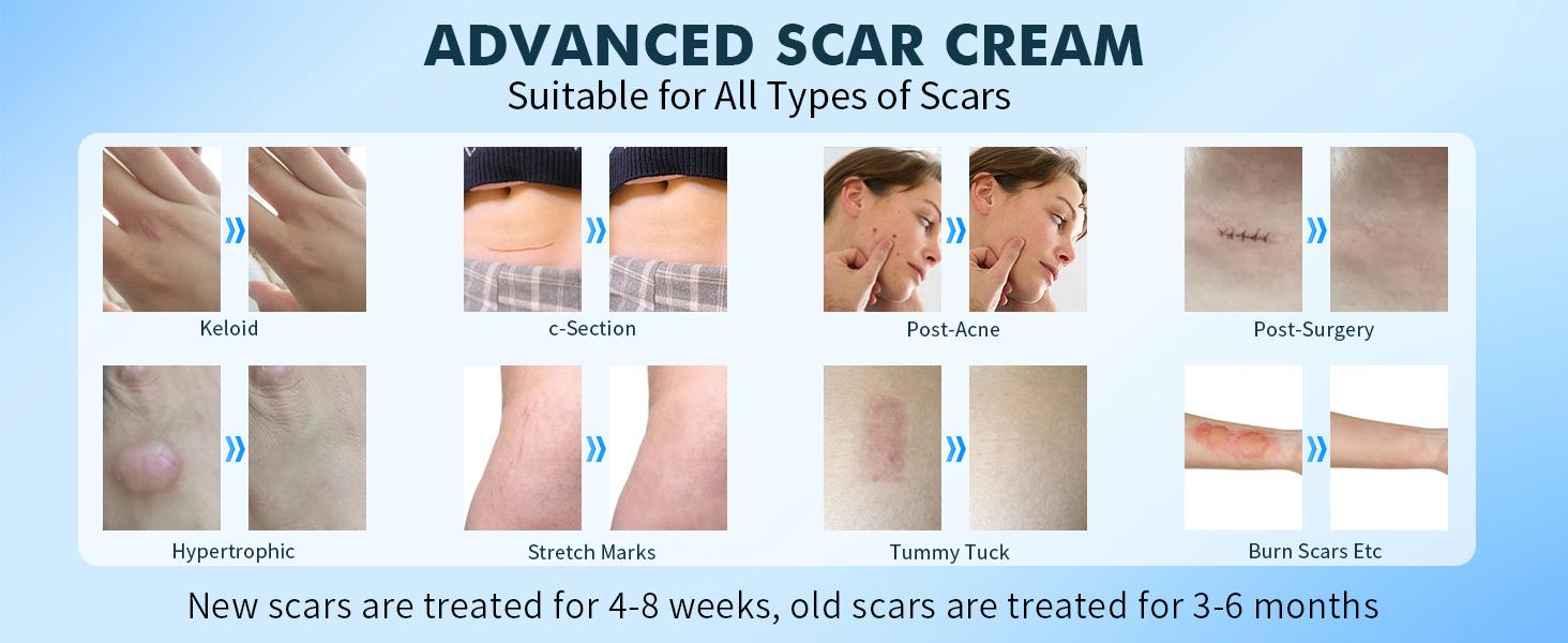 Scar Cream Gel, Advanced Silicone Scar Gel, Professional Scar Removal Cream for Surgical Scars, Stretch Mark, Keloid Bump, C-Section, Old and New Scars 1.7 oz(50g) Treatment Remedies Skin Tightening Oil Healthcare Therapeutic