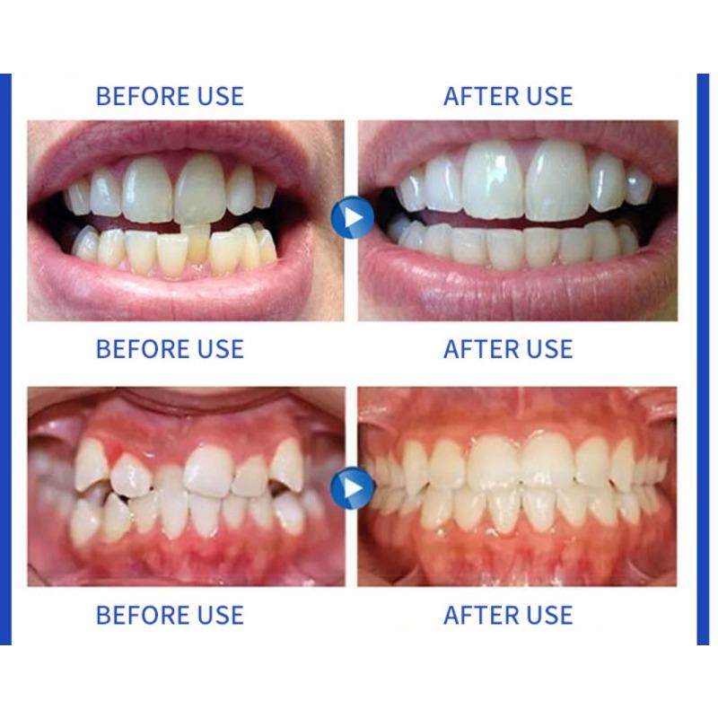 Silicone orthodontic braces Product with Storage Case, Comfortable to Wear, Safe to Use, Suitable for Both Men and Women