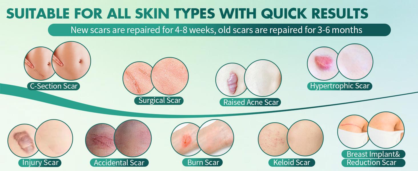 Scar Removal Silicone Tape 3M Roll (1.6 x 120) for Keloids, Surgical Scars C-Section & Burn Healing