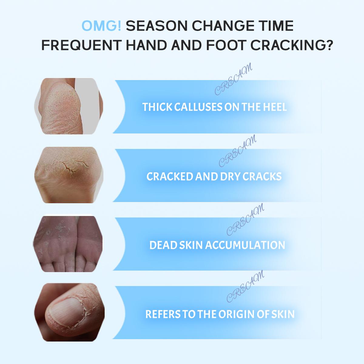 Two for one | VOVO ANGEL Anti-Crack Foot Cream, Cracked Heel Repair Stick | Dead Skin Remover for Dry Feet, Intensive Hydration & Nourishing Treatment for Extreme Cracked Feet Hydrating Hand Balm Hydrating Lotion Two for one | VOVO ANGEL Anti-Crack Foot Cream, Cracked Heel Repair Stick | Dead Skin Remover for Dry Feet, Intensive Hydration & Nourishing Treatment for Extreme Cracked Feet Hydrating Hand Balm Hydrating Lotion