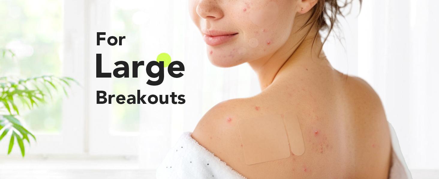 LitBear Skincare Large Pimple Patches 7 Sizes 306 Patches Acne Spot Treatment XL Hydrocolloid Bandages for Full Face Forehead Back and Body Skincare Mothers Day Gifts #Summervibes