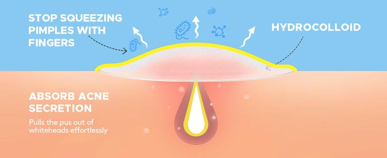 LitBear Star Acne Patches Pimple Patches, 6 Colors 168 Dots, Patches with Tea Tree Oil & Centella Oil, Hydrocolloid Acne Pimple Patches Perfect for Clear Skin