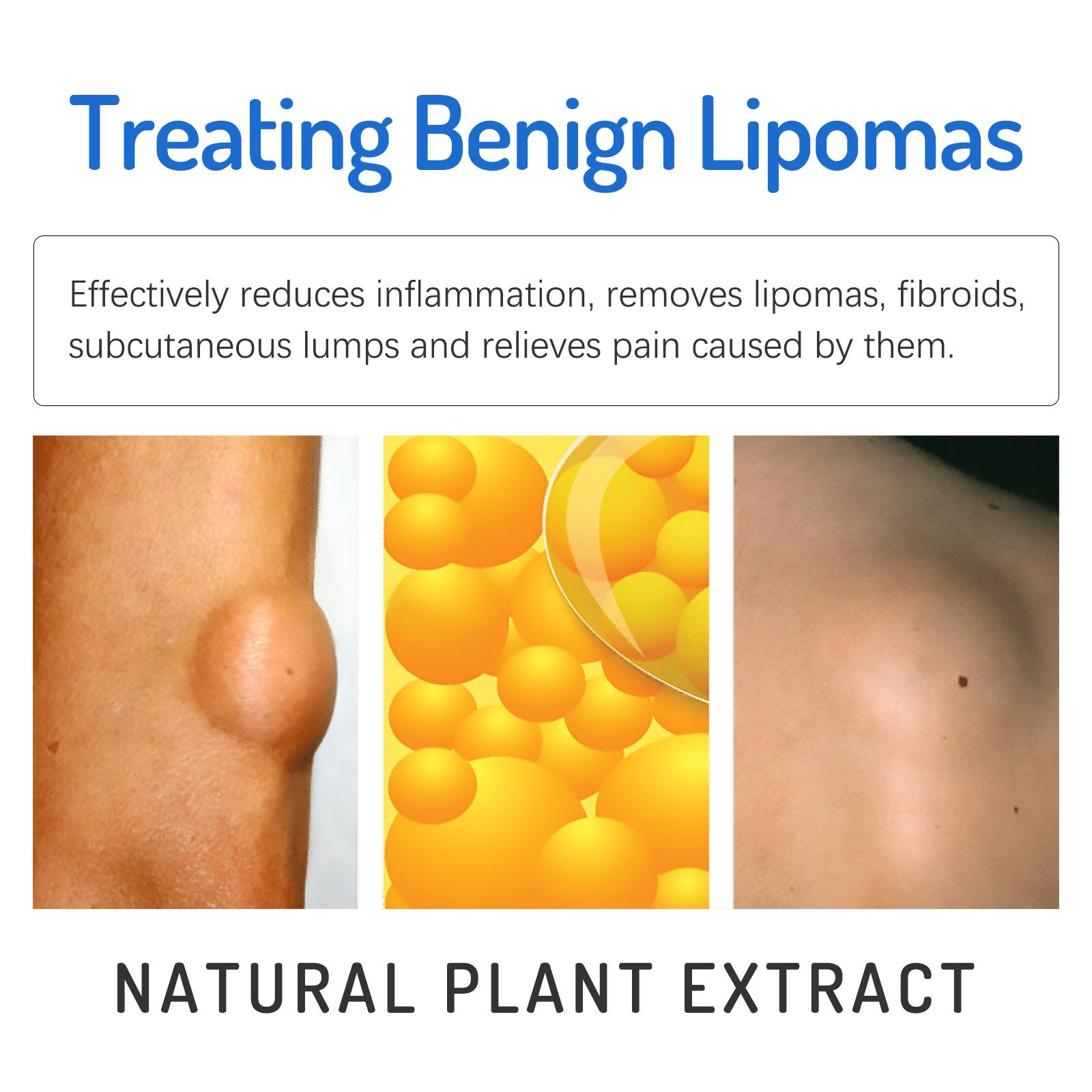 Relieve subcutaneous lumps caused by lipoma-fat cream