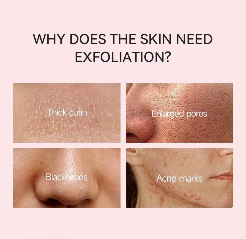【QINGLIN】Orange Exfoliating Enzyme Gel | Peeling Gel for Skin Care, Moisturizing Exfoliator Suitable for All Skin Types 100g Gentle Smoothing daily comfort  rene skin