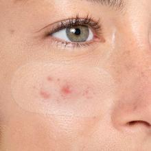 Large Acne Pimple Patches for Face Care ,Acne Spot Dots 5 Size 80pc Skincare, Watch Those Acne Spot Dots Work Their Magic for Skin Repair