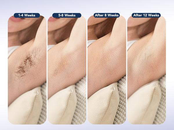 SKG Hair Freedom System, Dual-Pulse IPL for Contact-Free Hair Removal, Infinite Flashes, 25-Minute Full-Body Solution Electric Epilator Manual Epilator SKG Hair Freedom System, Dual-Pulse IPL for Contact-Free Hair Removal, Infinite Flashes, 25-Minute Full-Body Solution Electric Epilator Manual Epilator