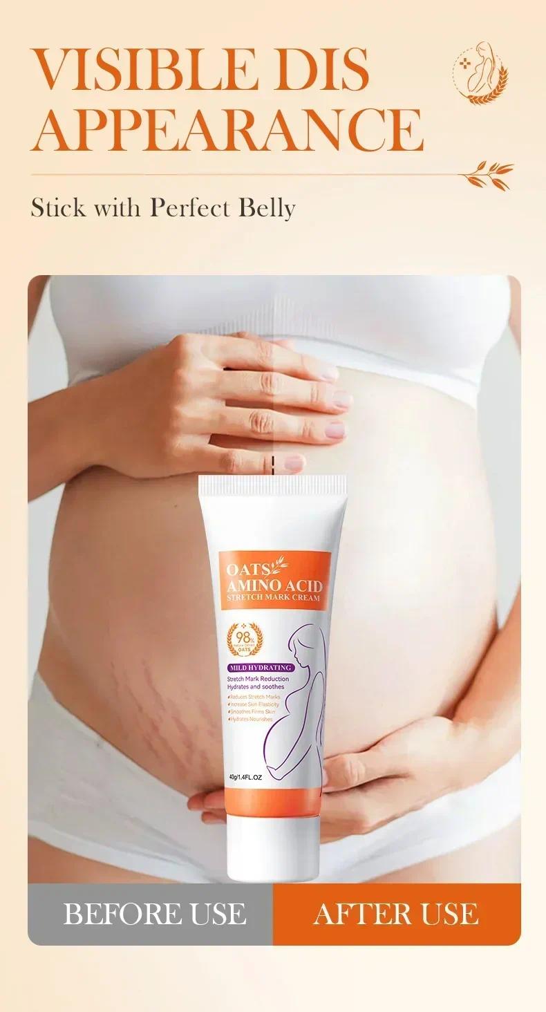 HOT SALE Stretch Marks Permanent Removal Eliminate Body Belly Stretch Marks Swelling Marks Remove Skin Cracks Repair Firming Car