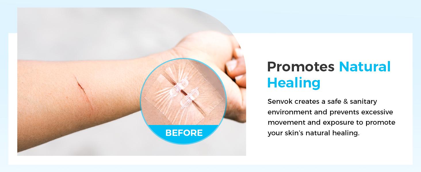 Senvok PU Sutures Butterfly Bandaids 4 Pcs Without Sew Quick Clot Emergency Wound Closures Device Laceration Kit Surgical Laceration Repair Healthcare