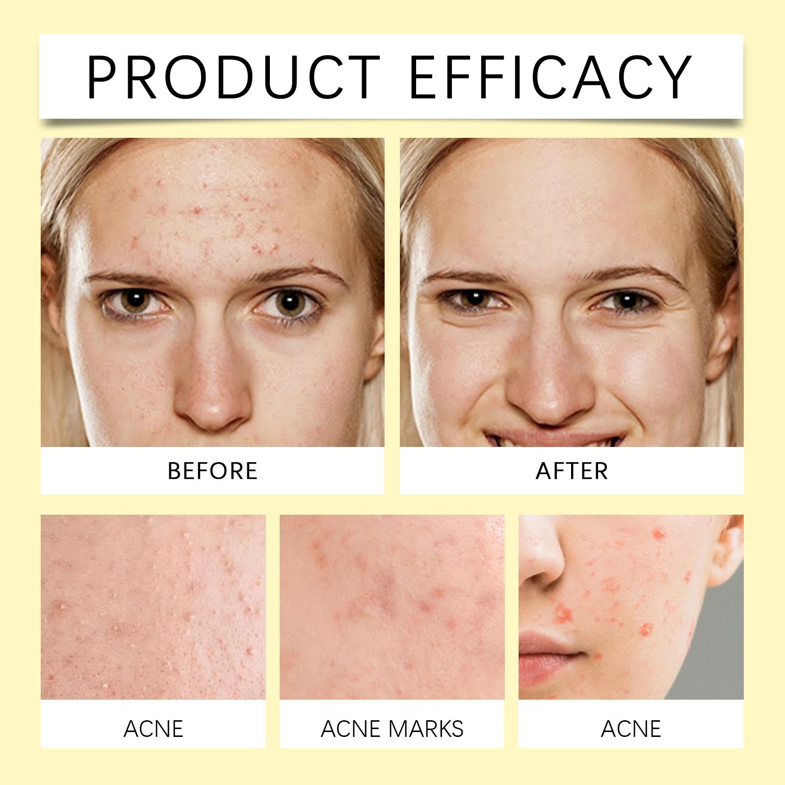 Stars Acne Patch, Reduce Acne Acne Print Clean Face Closed Mouth Acne Portable Cartoon Acne Patch