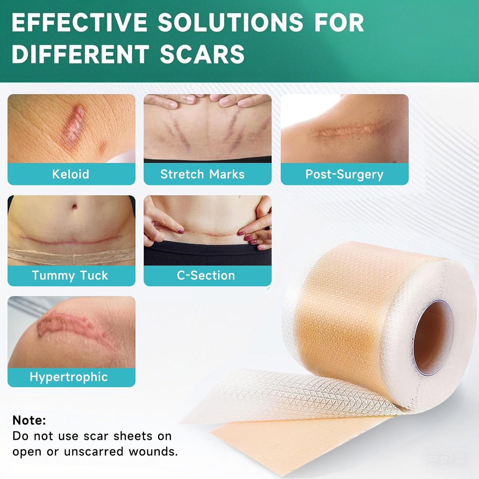 Suitable for All Skin Types,Reusable Silicone Scar Tape Strips Type for Keloid,Professional Silicone Scar Sheets,Burn, Acne Et. Suitable for All Skin Types,Reusable Silicone Scar Tape Strips Type for Keloid,Professional Silicone Scar Sheets,Burn, Acne Et.