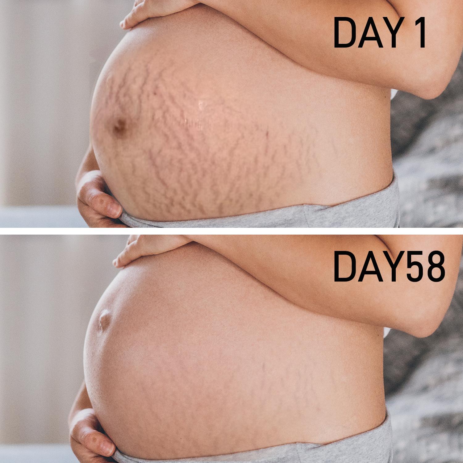 PEGO Stretch Mark Butter, Belly Moisturizer, Pregnant & Breastfeeding - Prevents & Heals Stretch Marks - Formula Enriched with Shea Butter & Vitamin E, 3.53 oz