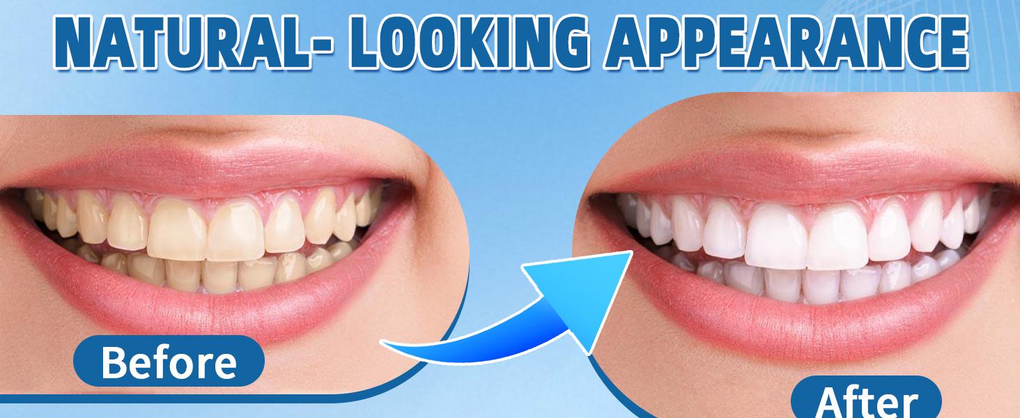 2026 Adjustable Snap-On Veneers Denture Set - Upper-Lower Teeth Covers, Natural Full Coverage Tooth Caps Kit for Adults