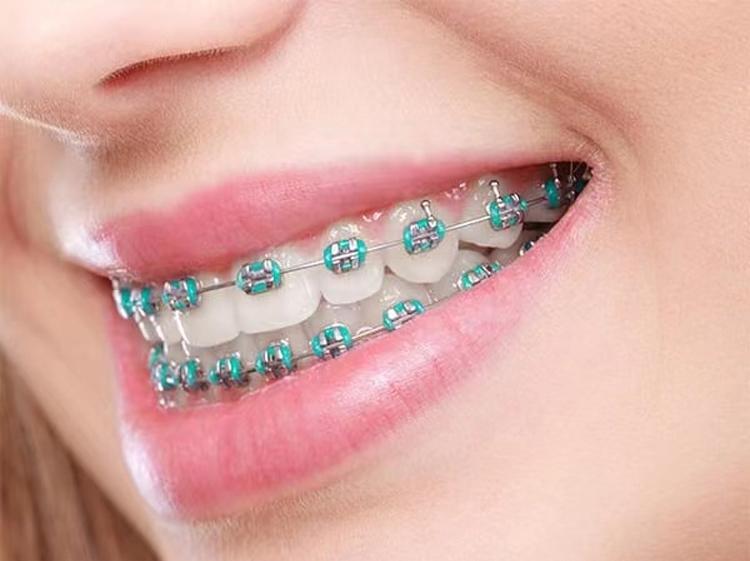 Simple Easy-Wear Tooth Beauty Decorations, Elegant Fashion for Men and Women, Perfect for Holidays and Parties, All Seasons