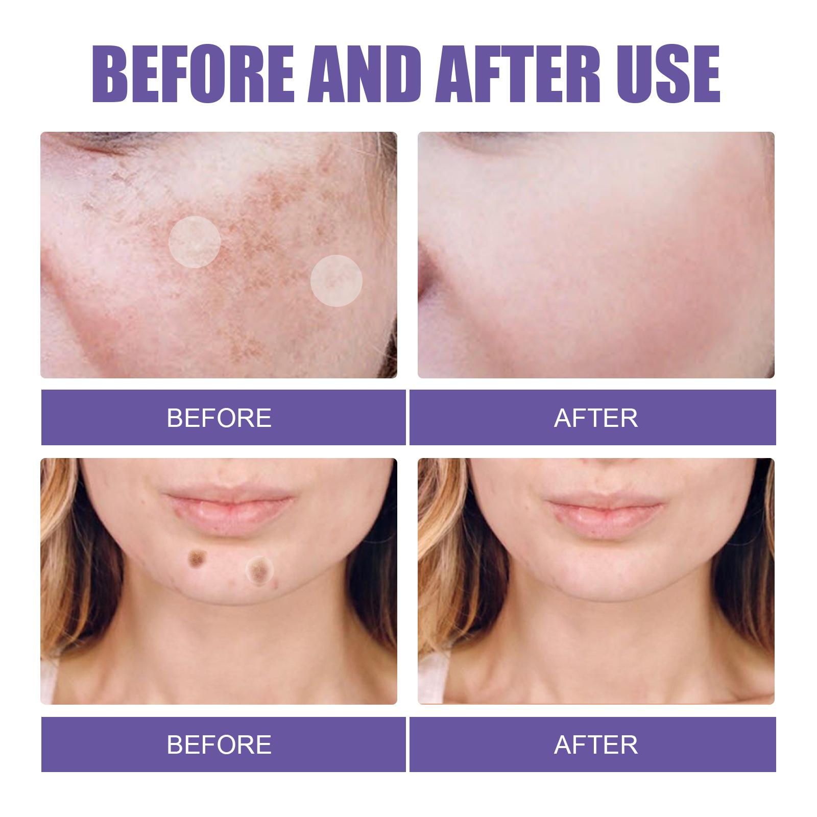 EELHOE Dark Spot Removal Patch, Lightening Face Dark Spots Melasma Spots Melanin Moisturizing Whitening Skin Spot Patch