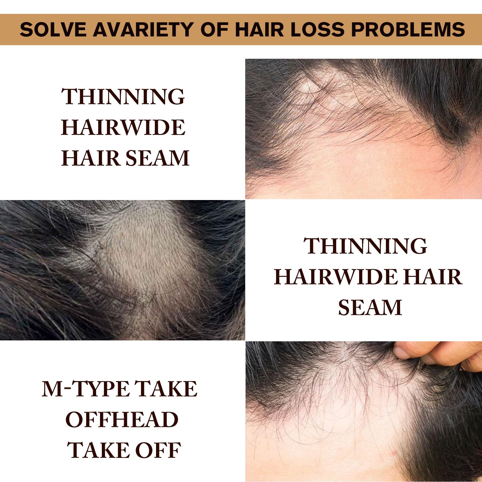 5% Minoxidil Serum, 1 Box/2 Boxes Hair Strengthening Serum, Strengthens Hair, Scalp Treatment Serum, Hair Regrowth Serum, Thicker Looking Hair, Scalp Care Product for Men & Women, Hair Care Product for Daily Use, Haircare
