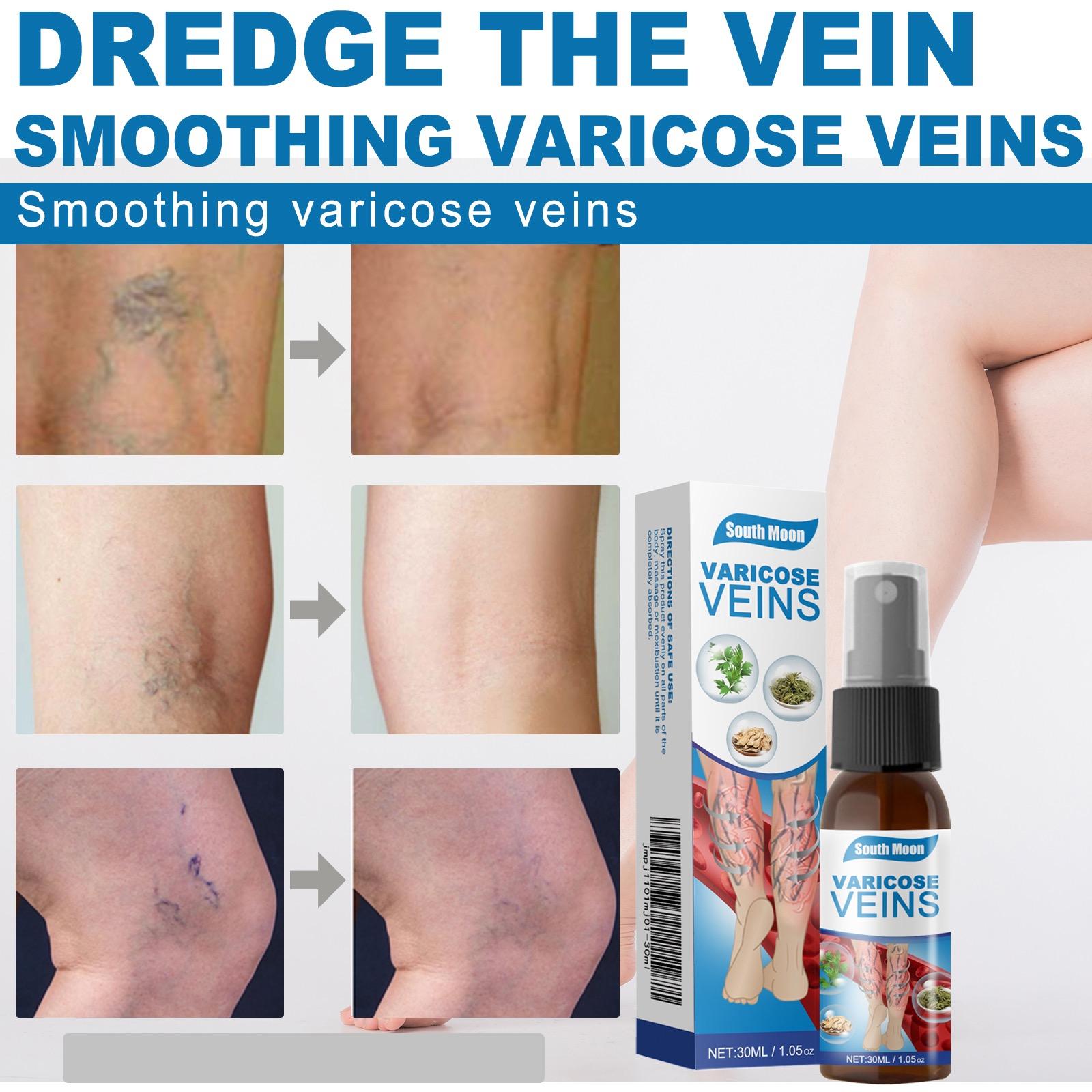 South Moon Leg Care Spray Gently Relieve Leg Discomfort, Blue Veins And Bumps Repair Daily Care