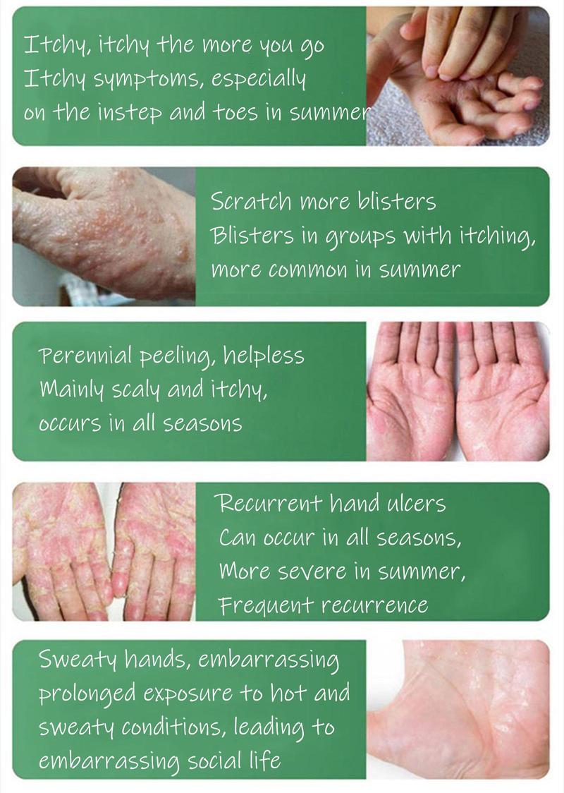 SanNuo Herbal Antibacterial Soothing Cream – Relieves Eczema, Psoriasis & Itching, Safe for Dry & Sensitive Skin, Zero Hormone & Fragrance-Free Creme for Eczema