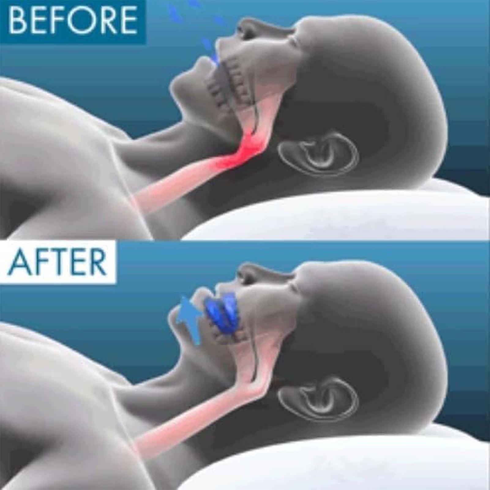 Gum Shield for Snoring Stop Anti Snoring Mouthpiece Snore Device Stopper Reduce Snoring Aid Snore Solution for Easy Breathing