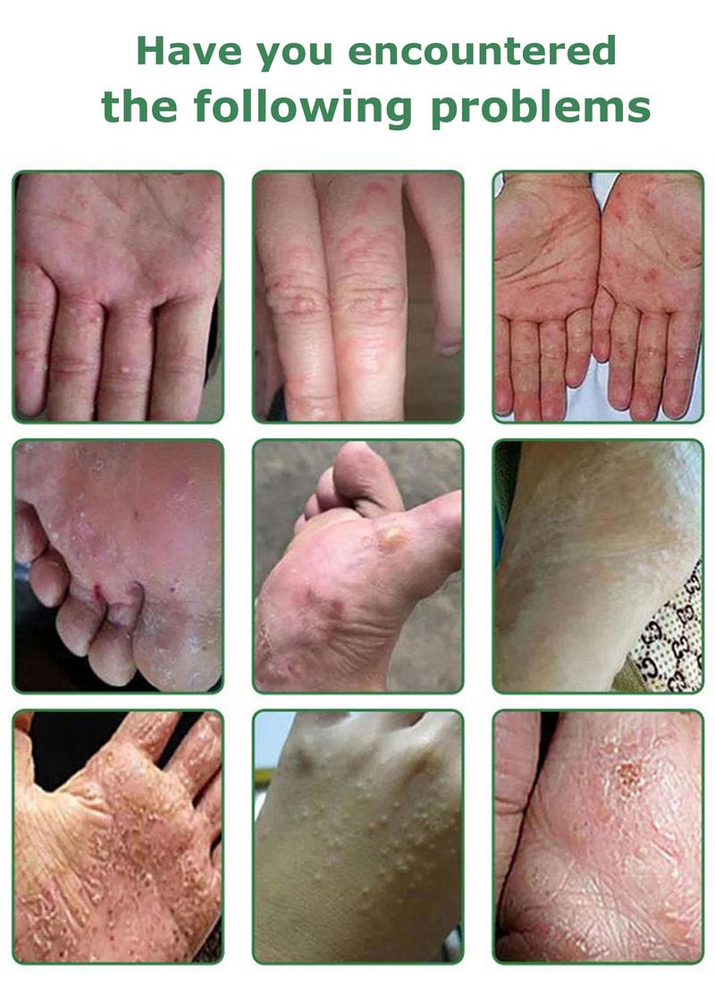 SanNuo Herbal Antibacterial Soothing Cream – Relieves Eczema, Psoriasis & Itching, Safe for Dry & Sensitive Skin, Zero Hormone & Fragrance-Free Creme for Eczema