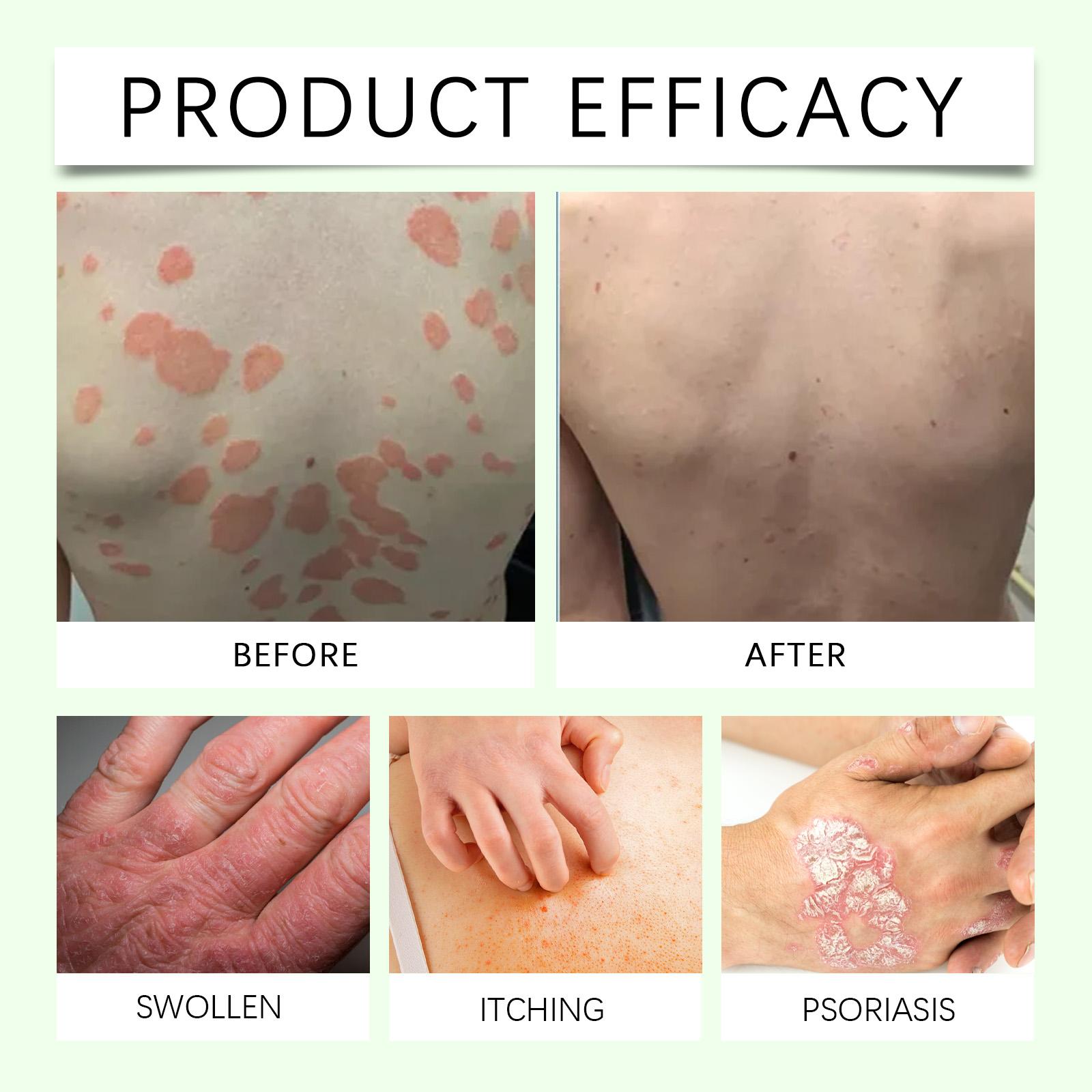 WoodSleep Herbal Cream, Herbal Formula Relieves Skin Redness And Moisturizes Skin Externally