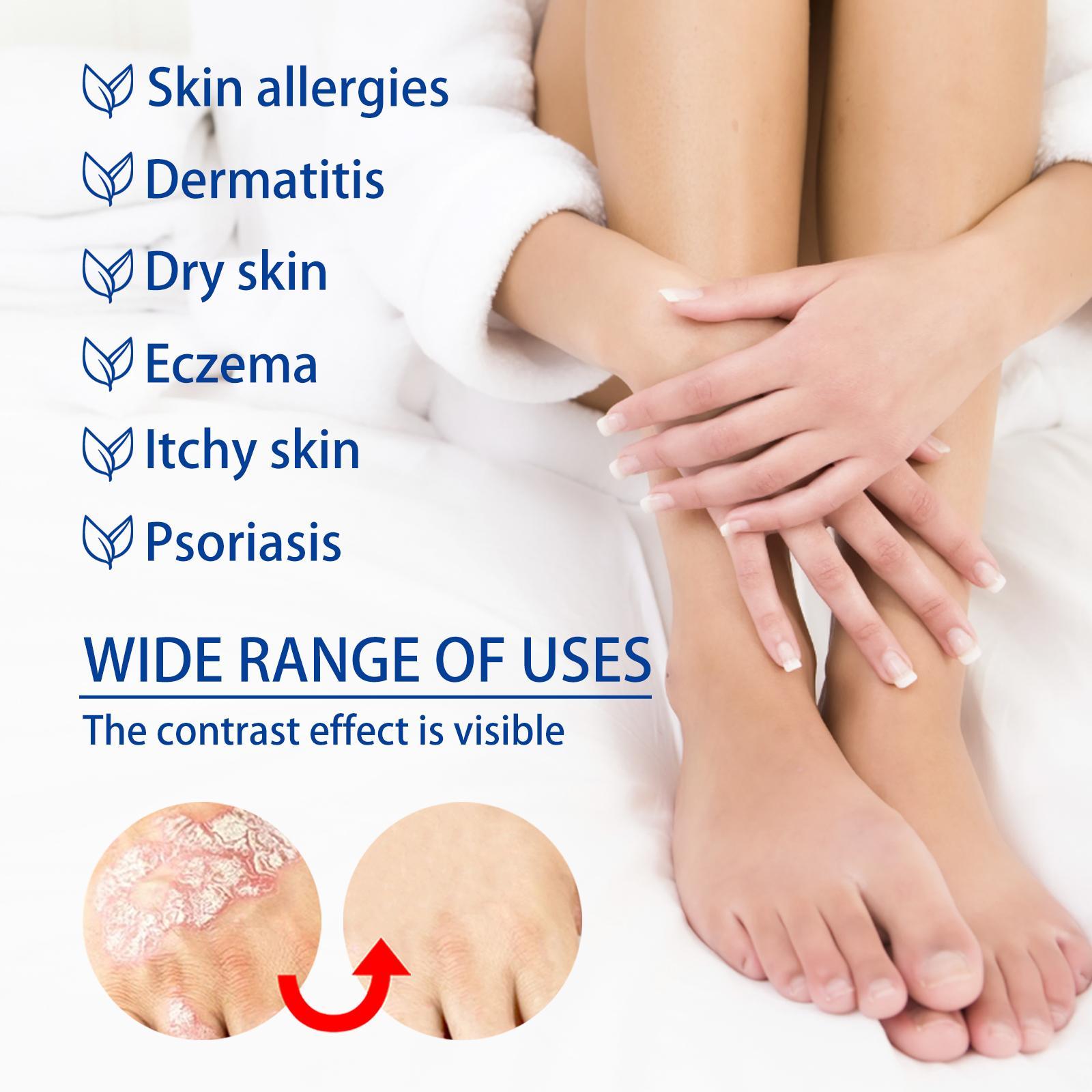 All-Natural Soothing Antifungal Cream | Plant-Based Treatment for Ringworm & Jock Itch | Gentle Relief for Eczema, Psoriasis & Rashes | Fast-Acting Skin Repair Formula