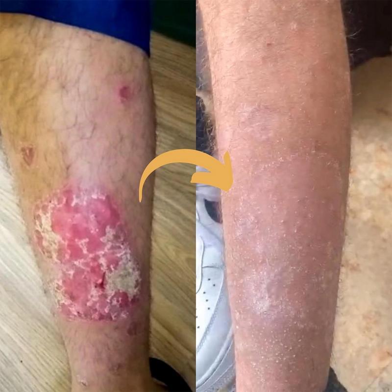 All-Natural Herbal Soothing Cream | Eczema & Psoriasis Relief | Anti-Bacterial Skin Defense | Hydrates Dry, Itchy, Sensitive Skin | Plant-Based Balm for Whole Family | Ancient Formula, 30g | Safe for All Ages | Perfect Christmas/New Year Gifts